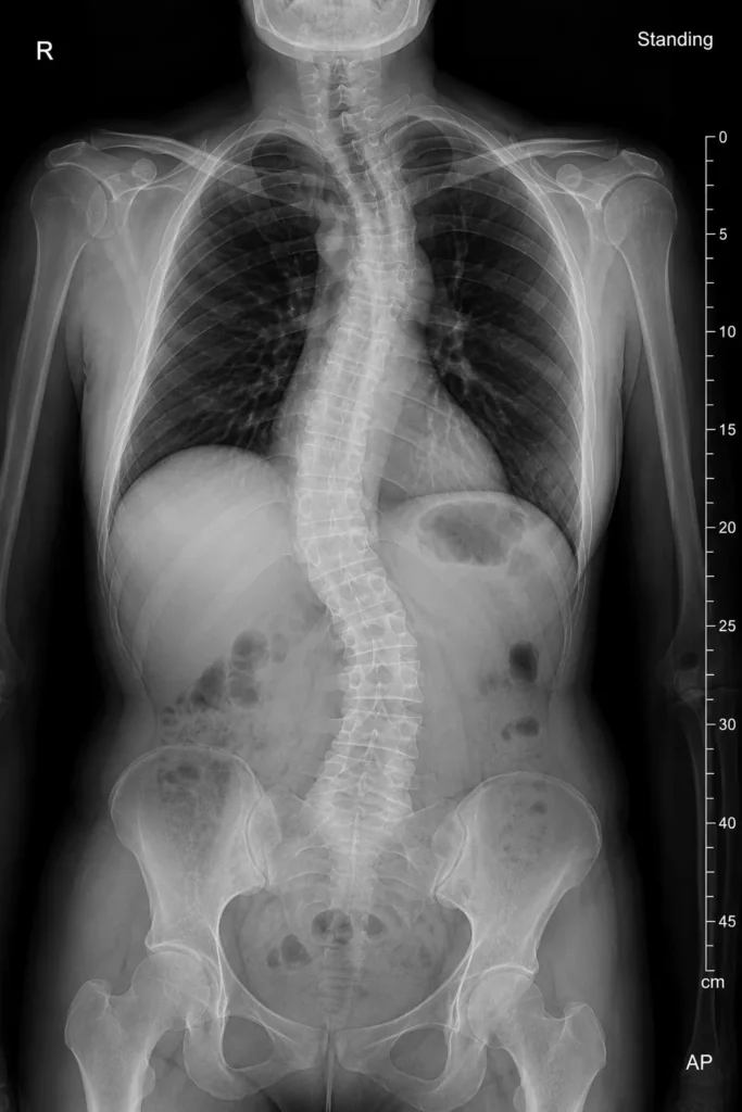 X-ray demonstrating adult scoliosis and spinal curvature