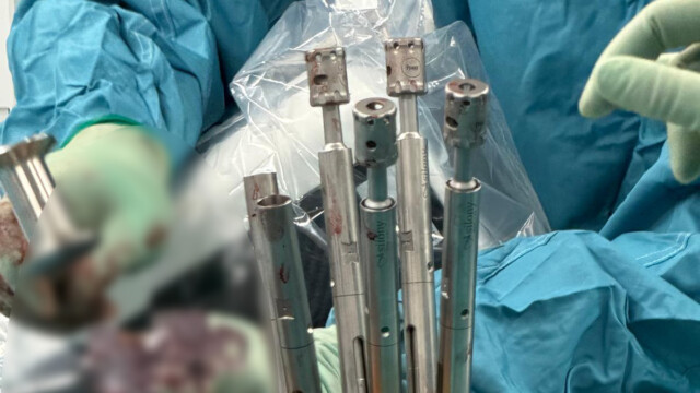 Close-up view of pedicle screws used in spinal fixation surgery Close-up view of pedicle screws used in spinal fixation surgery